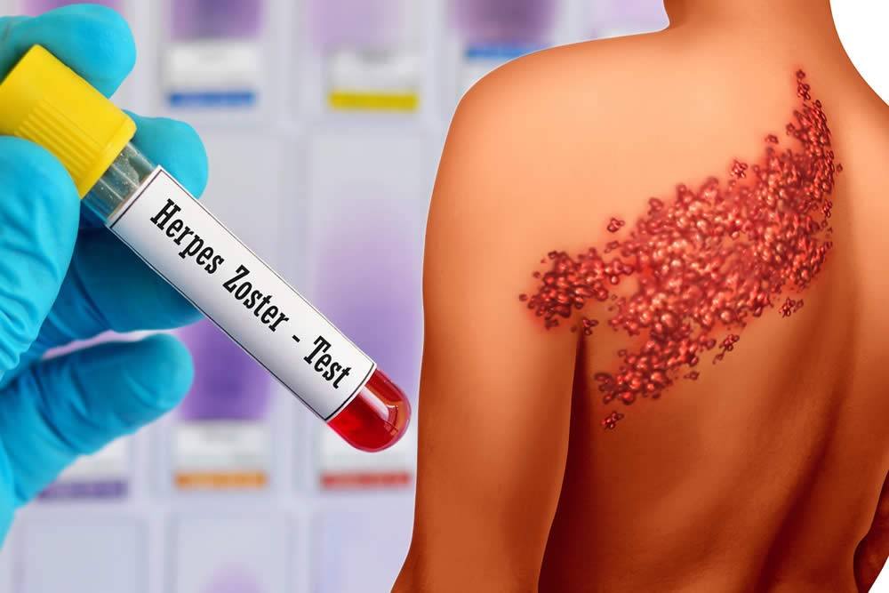 Herpes Type 1 & 2